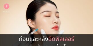 การดูแลตัวเองก่อนและหลังฉีดฟิลเลอร์