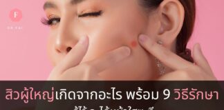 วิธีรักษาสิวผู้ใหญ่