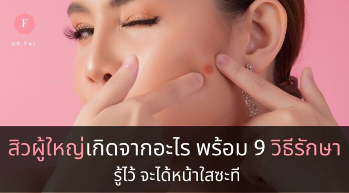วิธีรักษาสิวผู้ใหญ่