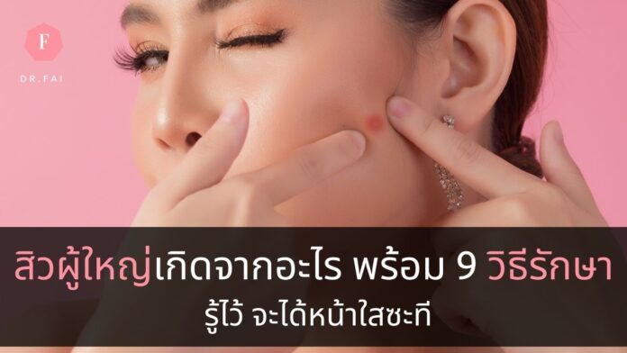 22adultacne วิธีรักษาสิวผู้ใหญ่
