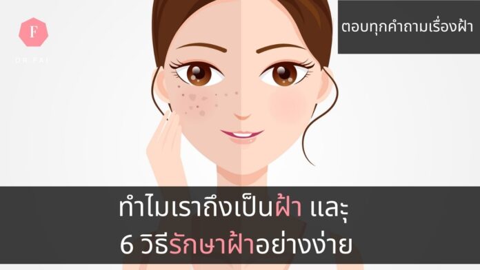 4สาเหตุการเกิดฝ้า