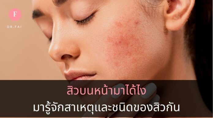 สาเหตุการเกิดสิว