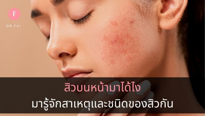 40typeacne สาเหตุการเกิดสิว
