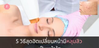 วิธีรักษาหลุมสิว