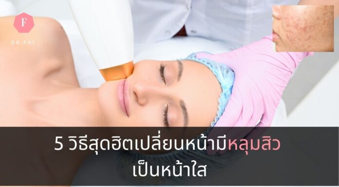 5 วิธีสุดฮิตเปลี่ยนหน้ามีหลุมสิว เป็นหน้าใส วิธีรักษาหลุมสิว