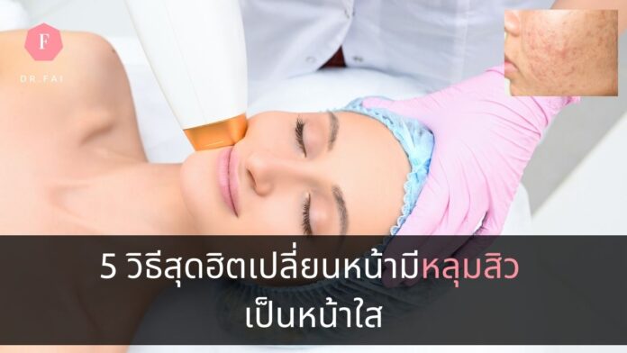 วิธีรักษาหลุมสิว