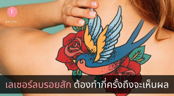 เลเซอร์ลบรอยสัก ต้องทำกี่ครั้งถึงจะเห็นผล เลเซอร์ลบรอยสัก