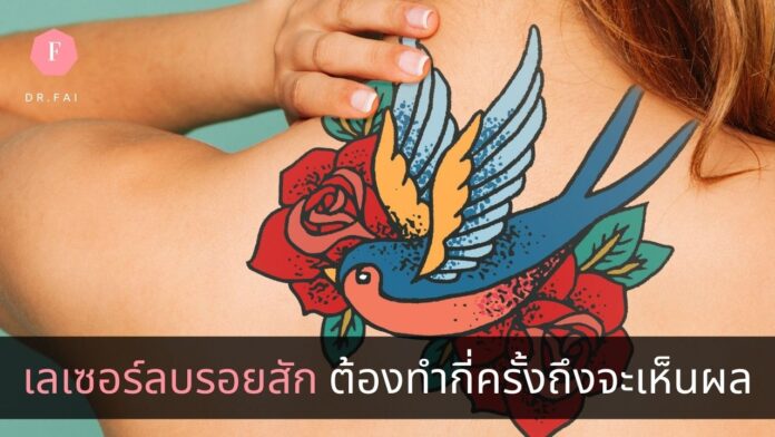 เลเซอร์ลบรอยสัก