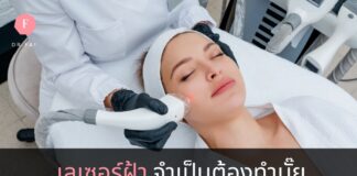 เลเซอร์ฝ้า