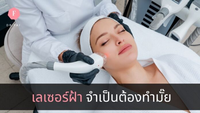 เลเซอร์ฝ้า
